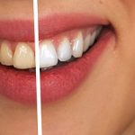 Dangers of “Do-It-Yourself” Teeth Whitening